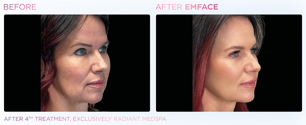 EMFACE Before and After